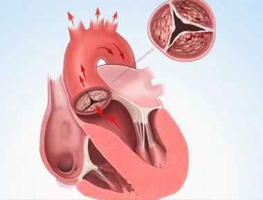 Στένωση αορτής: Τι είναι, συμπτώματα και ποιοι κινδυνεύουν! (βίντεο)